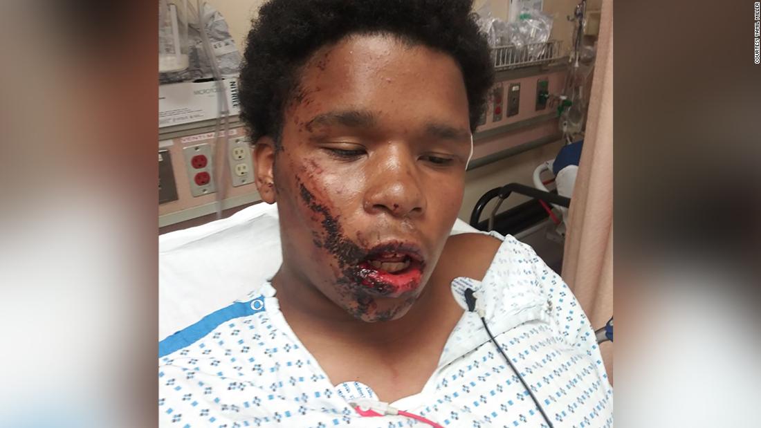A Bronx teenager suffered facial fractures after the NYPD allegedly cursed him, a lawyer told CNN
